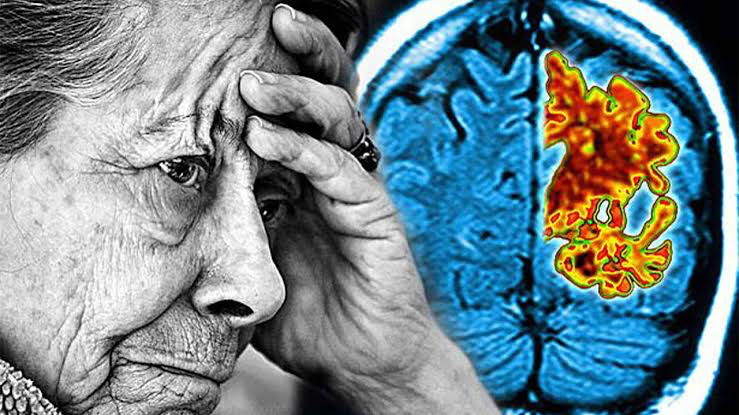 Dünya Alzheimer Ayı: Farkındalık ve Mücadele İçin Bir Ay